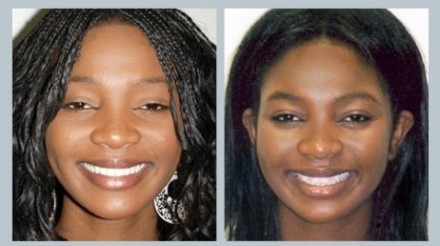 Invisalign Before & After