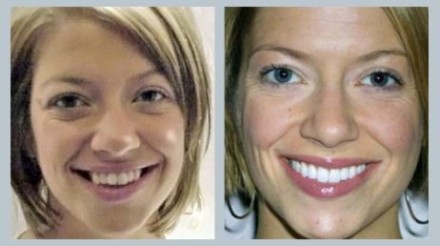 Invisalign Before & After