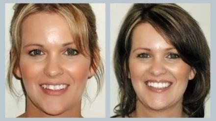 Invisalign Before & After