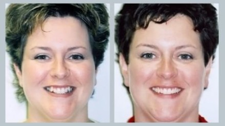 Invisalign Before & After