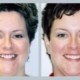 Invisalign Before & After