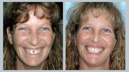 Invisalign Before & After