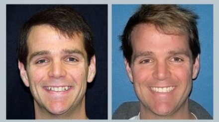Invisalign Before & After