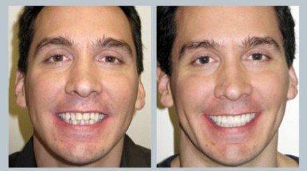 Invisalign Before & After