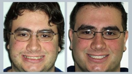 Invisalign Before & After