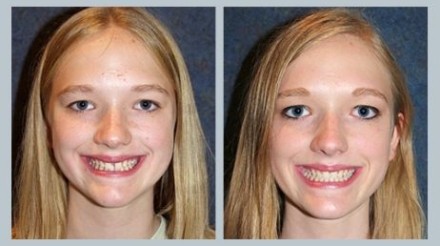 Invisalign Before & After