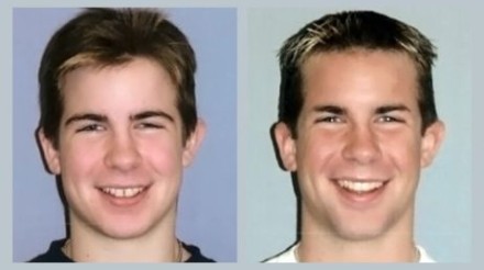 Invisalign Before & After