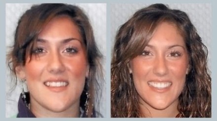 Invisalign Before & After