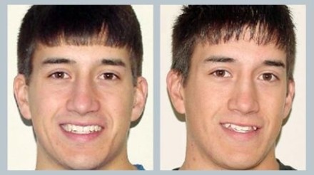 Invisalign Before & After