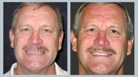 Invisalign Before & After