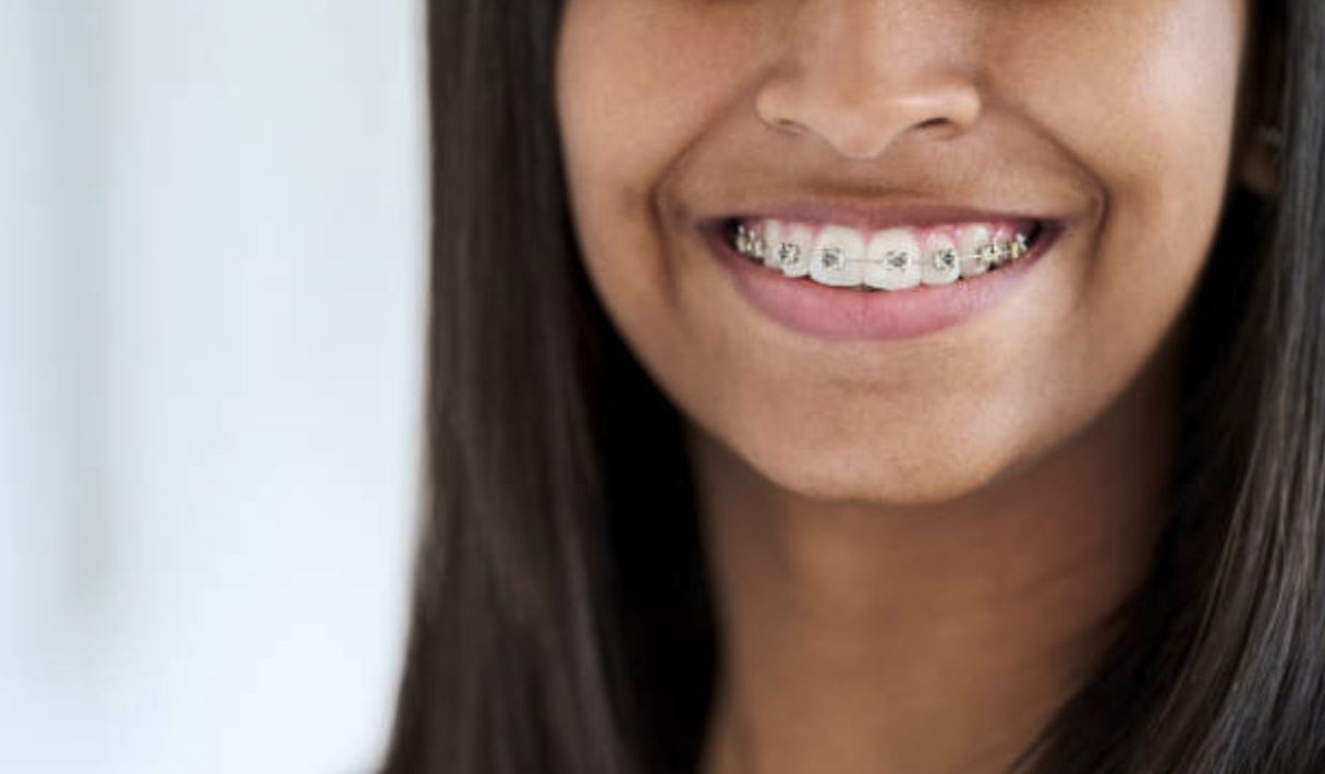 Girl wearing braces and smiling with clean, white teeth.